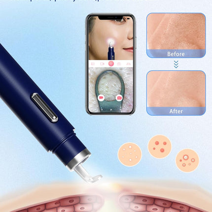 Visual Blackhead Remover with Camera 20X Extractor Kit for iPhone/Android